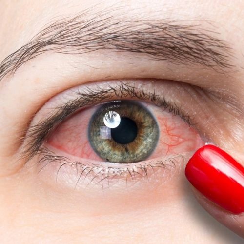 صورة مقربة تظهر احمرار العين الناتج عن حالة صحية