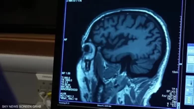 مجهر طبي وعينات دم ترمز لاكتشاف تحليل الدم الجديد لتشخيص الزهايمر