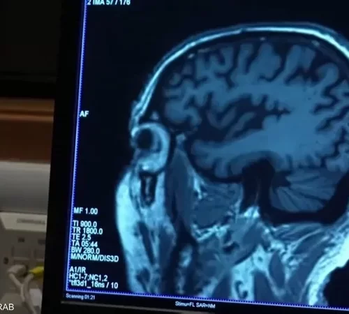 مجهر طبي وعينات دم ترمز لاكتشاف تحليل الدم الجديد لتشخيص الزهايمر